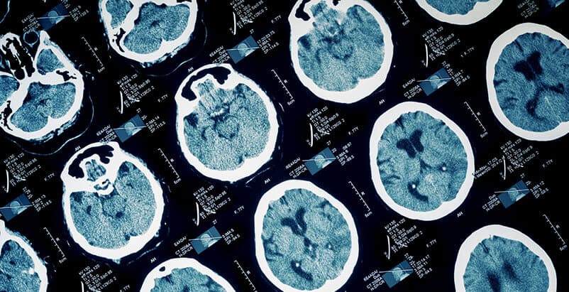 Chicago Brain Injury Attorneys Chicago Brain Injury Attorneys