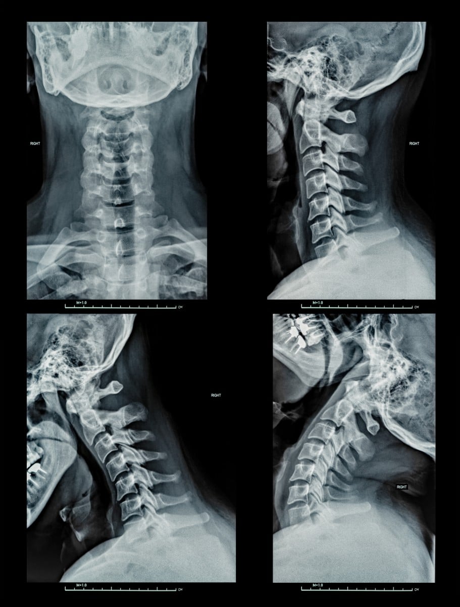 Can You Break Your Neck and Not Know It? Gainsberg Law